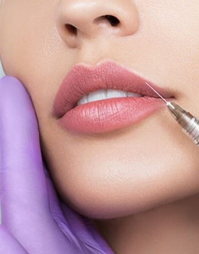 Radiesse Filler